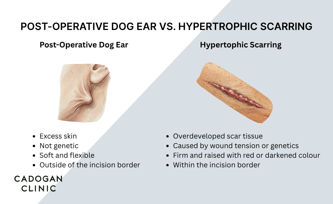 An infographic showing the difference between post-operative dog ears and hypertrophic scarring